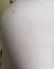 Chicken pox again?