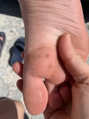 What’s this on my child’s foot??