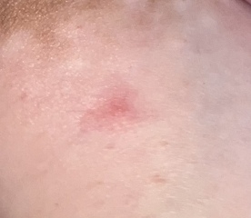Red patch of skin on breast??