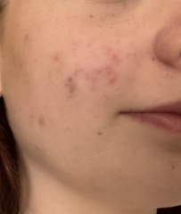 Teenage acne HELP