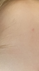 Molluscum Contagiosum?
