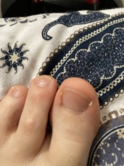 Dark line/mark near toe