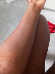 Rapidly expanding rash