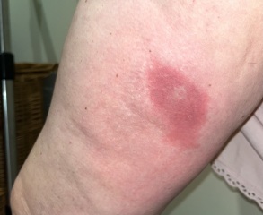 Is this cellulitis?