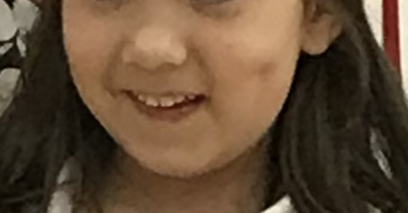 Dimple caused by cheek injury