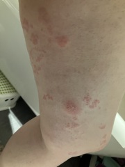Maybe shingles on my leg? Pic!
