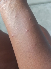 Rapidly expanding rash