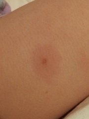 Spots on face and groin