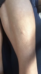 Lumpy Legs