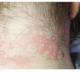 Does anyone know what this rash is?