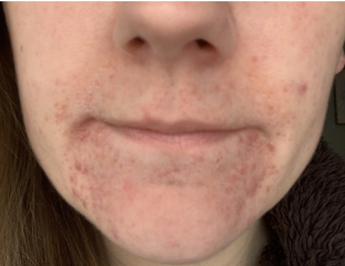 Perioral dermatitis - is it a perimenopause thing?! Has anyone got rid of it?