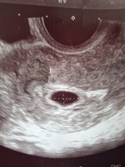 Early scan, twins?