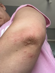 Rash… on elbows?!?!
