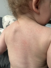Help what's this rash?