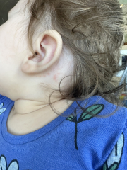 Please read panicking about chicken pox