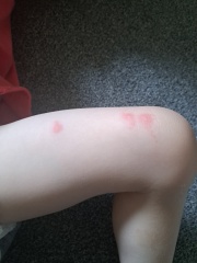 Bites or allergy?