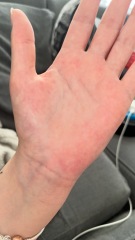 Rash on hands -36 weeks