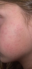 Viral infection rash?