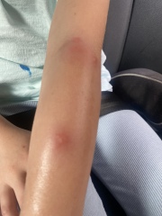 Mosquito bites?? Or something else