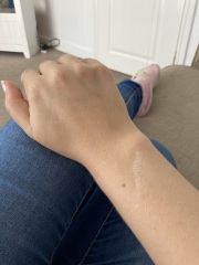 Recalled after a mole scan.