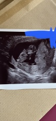 12 week scan sex guesses