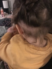 Hair loss/thinning (hairline/nape) in toddler