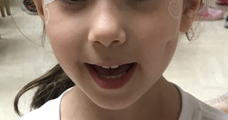 Dimple caused by cheek injury