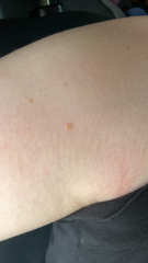 Does this lump seem suspicious