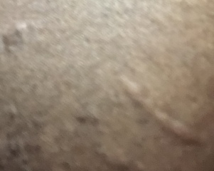 Chronic hives on boobs , PLS help .I’m miserable
