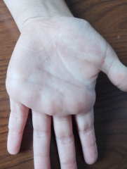 Does anyone know what this rash might be