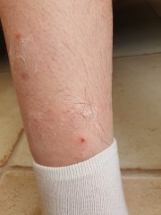 Bed bugs or fleas?