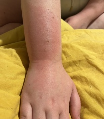 Dd bug bite (pic) antihistamines /ibuprofen anything else to help avoid antibiotics?