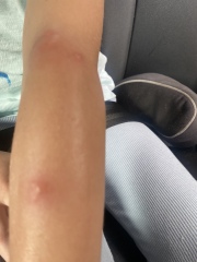 Mosquito bites?? Or something else