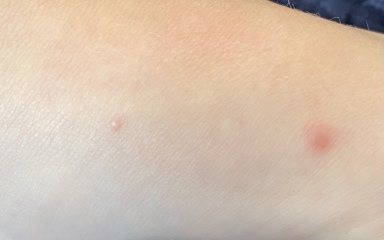 Molluscum Contagiosum?