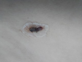 (sensitive pics of wound )surgical incision infected?