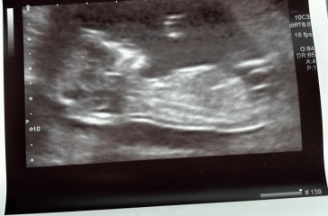 12 week scan