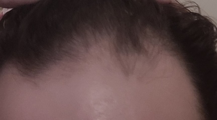 Hairstyle for thinning hairline at front.