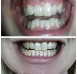 Adult braces