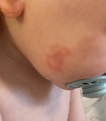 Ringworm or…not?
