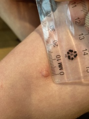 What’s this on my son’s leg?