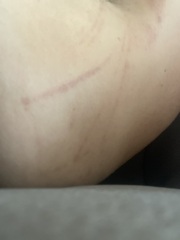 Burst blood vessels ? Pic included