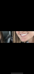 Adult braces