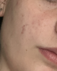 Teenage acne HELP