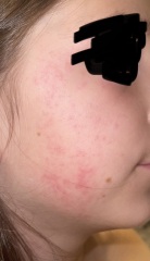 Viral infection rash?