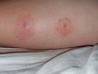 Does this look like lymes disease?