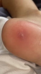 Verruca or something else?