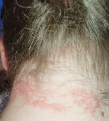 Does anyone know what this rash is?
