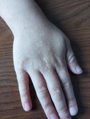 Does anyone know what this rash might be