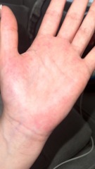 Rash on hands -36 weeks