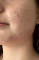 Teenage acne HELP
